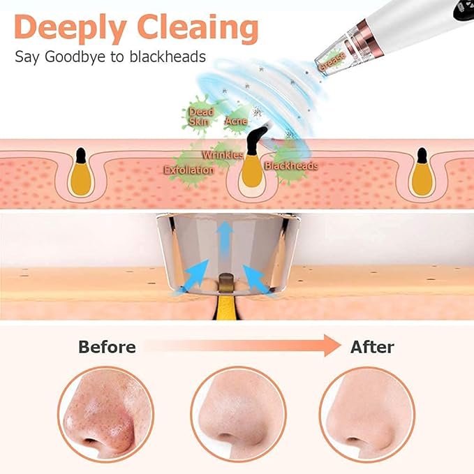 ClearSuctionix 6 In 1 Black & Whitehead Remover