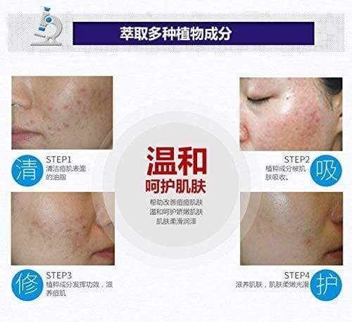 BioAqua Acne & Scar Remover (50% Off) BioAqua Acne & Scar Remover (50% Off)