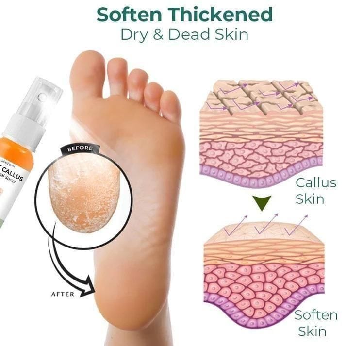 Foot Callus Removal Spray(Pack Of 2) Foot Callus Removal Spray(Pack Of 2)
