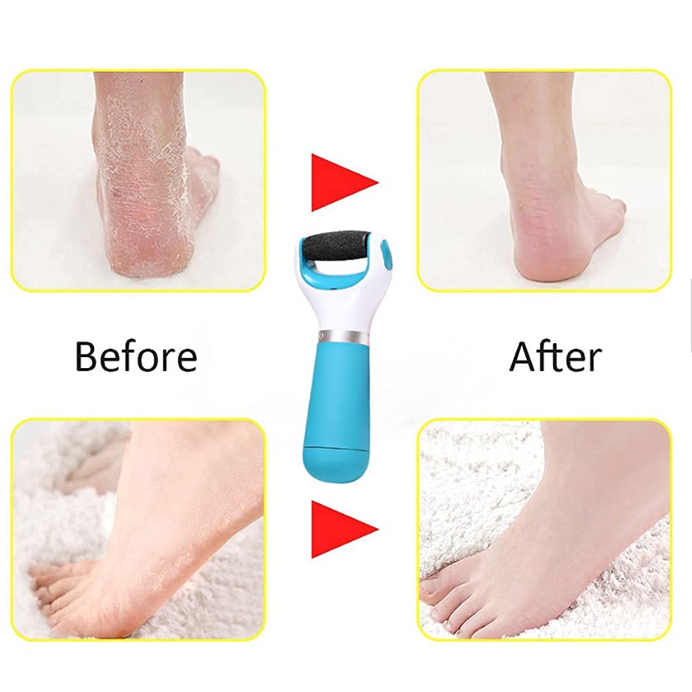 Foot Roller Callus Remover | Foot Scrubber Dead Skin Remover For Feet Foot Roller Callus Remover