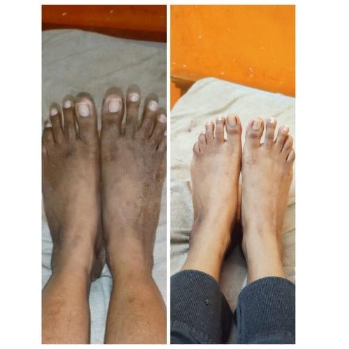 Kojic Body Soap | Skin Whitening Soap Dark Spots On Skin Tone Kojic Body Soap (Pack of 3)