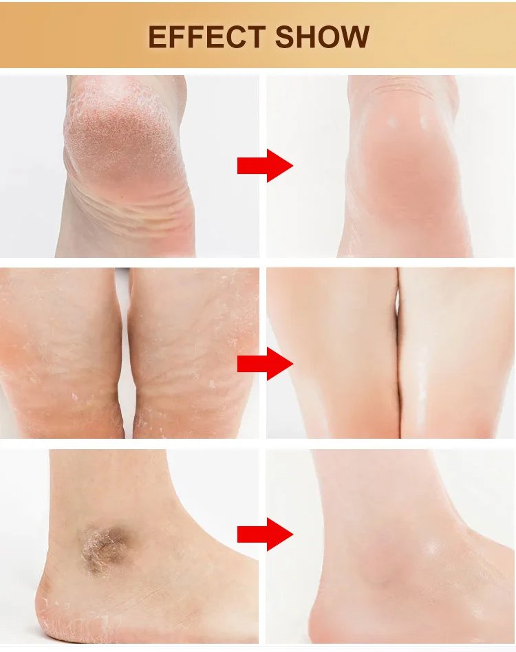 Stainless Steel Foot File | Foot Scrubber Callus Remover Skin Care Products Foot Scrapper - Black - Stainless Steel Foot File