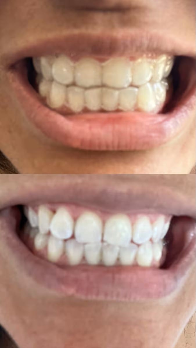 Teeth Whitening Strip (Pack of 7 Pair Strips) | Teeth Whitening Strips Brithening Bleached Teeth Denstist Kit Teeth Whitening Strip (Pack of 7 Pair Strips)