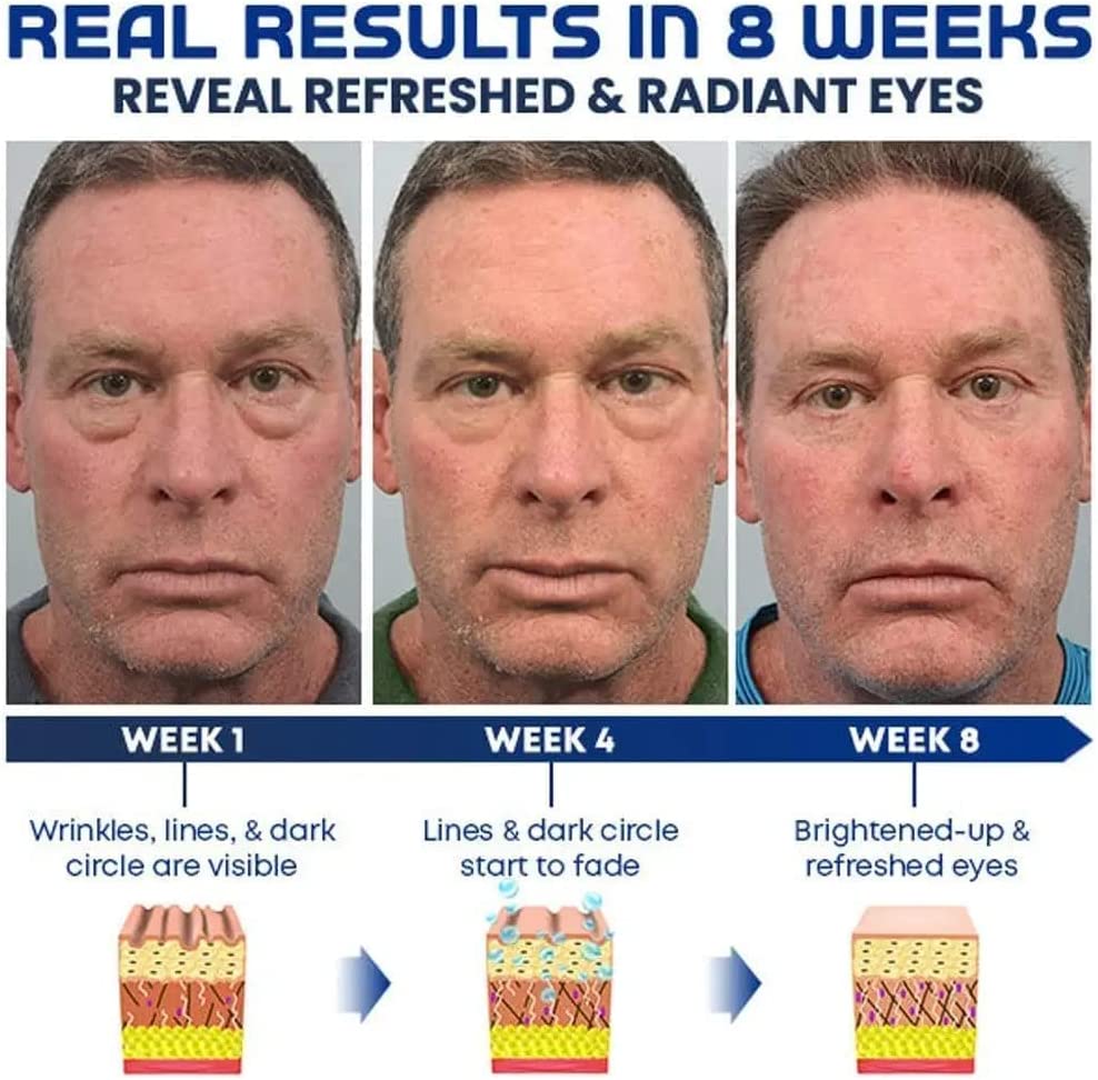 Under Eye Cream For Dark Circles Eyes Lifting Under Eye Gel (50% OFF) Under Eye Gel (50% OFF)