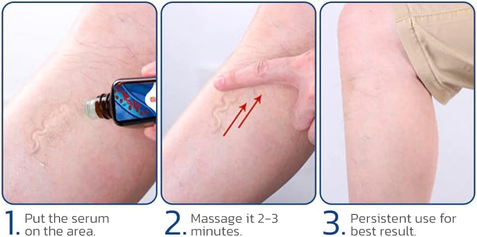 Herbal Varicose Vein Oil - Buy 1 Get 1 Free Herbal Varicose Vein Oil - Buy 1 Get 1 Free