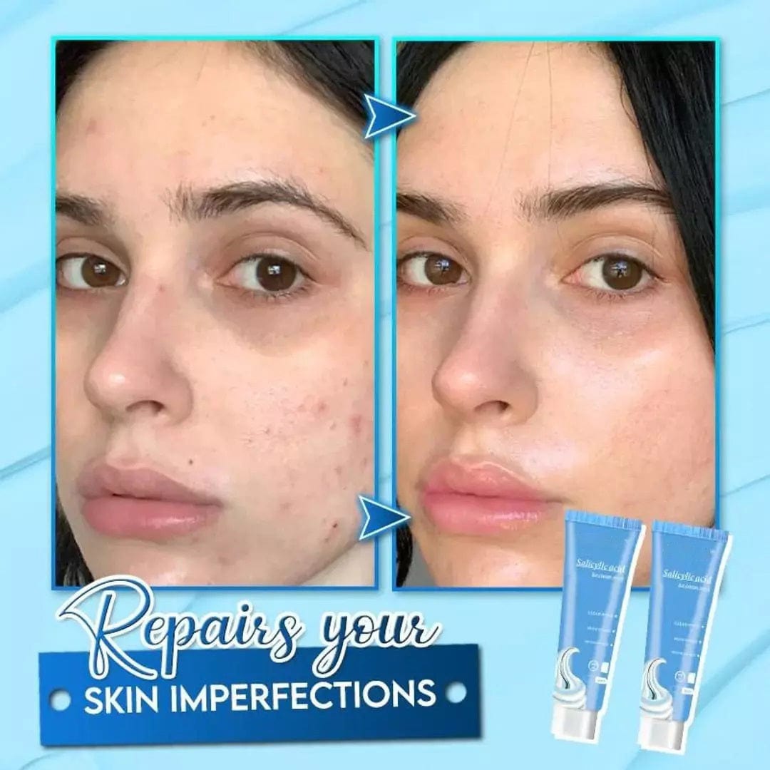 Salicylic Acid Wart Remover Black Head Removal Gel For Acne Salicylic Acid Face Mask