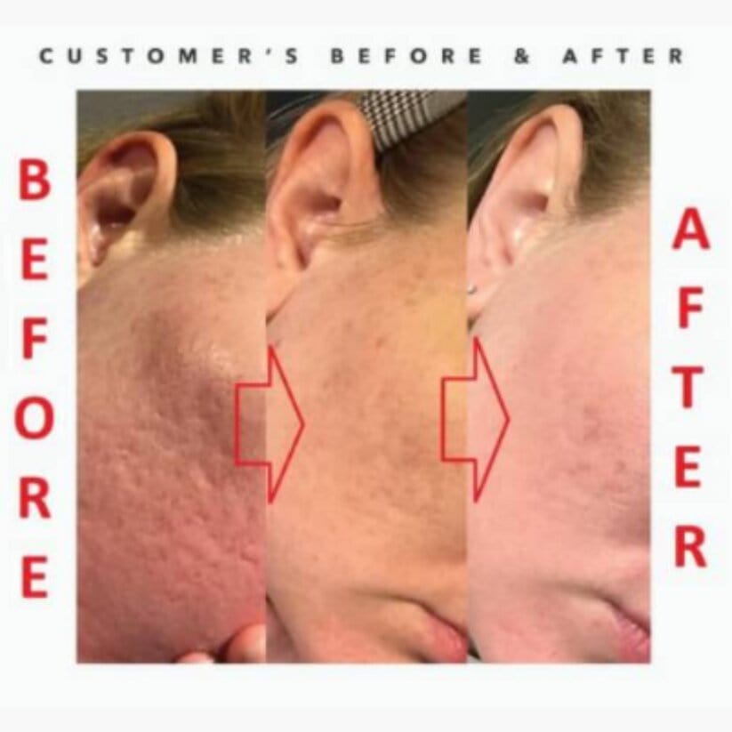 Acne Face Serum (30 ml) Acne Face Serum (30 ml)