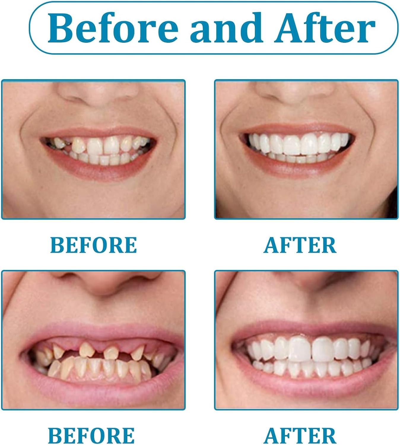 Ezysmyl Snap-on Dentures | White Teeth Braces Clip On Veneer Teeth