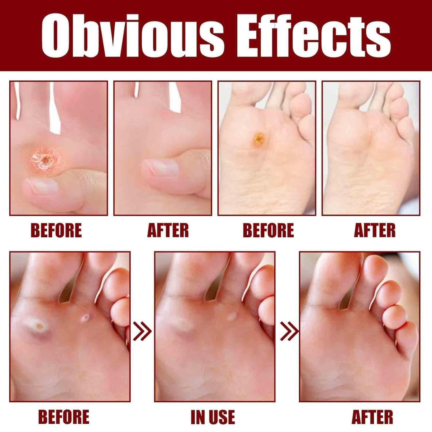 Feet Corn Removal Serum (Pack of 2) | Foot Corn Treatment Corn Healing Feet Corn Removal Serum (Pack of 2)