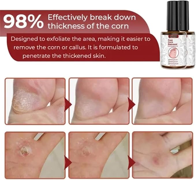Feet Corn Removal Serum (Pack of 2) | Foot Corn Treatment Corn Healing Feet Corn Removal Serum (Pack of 2)