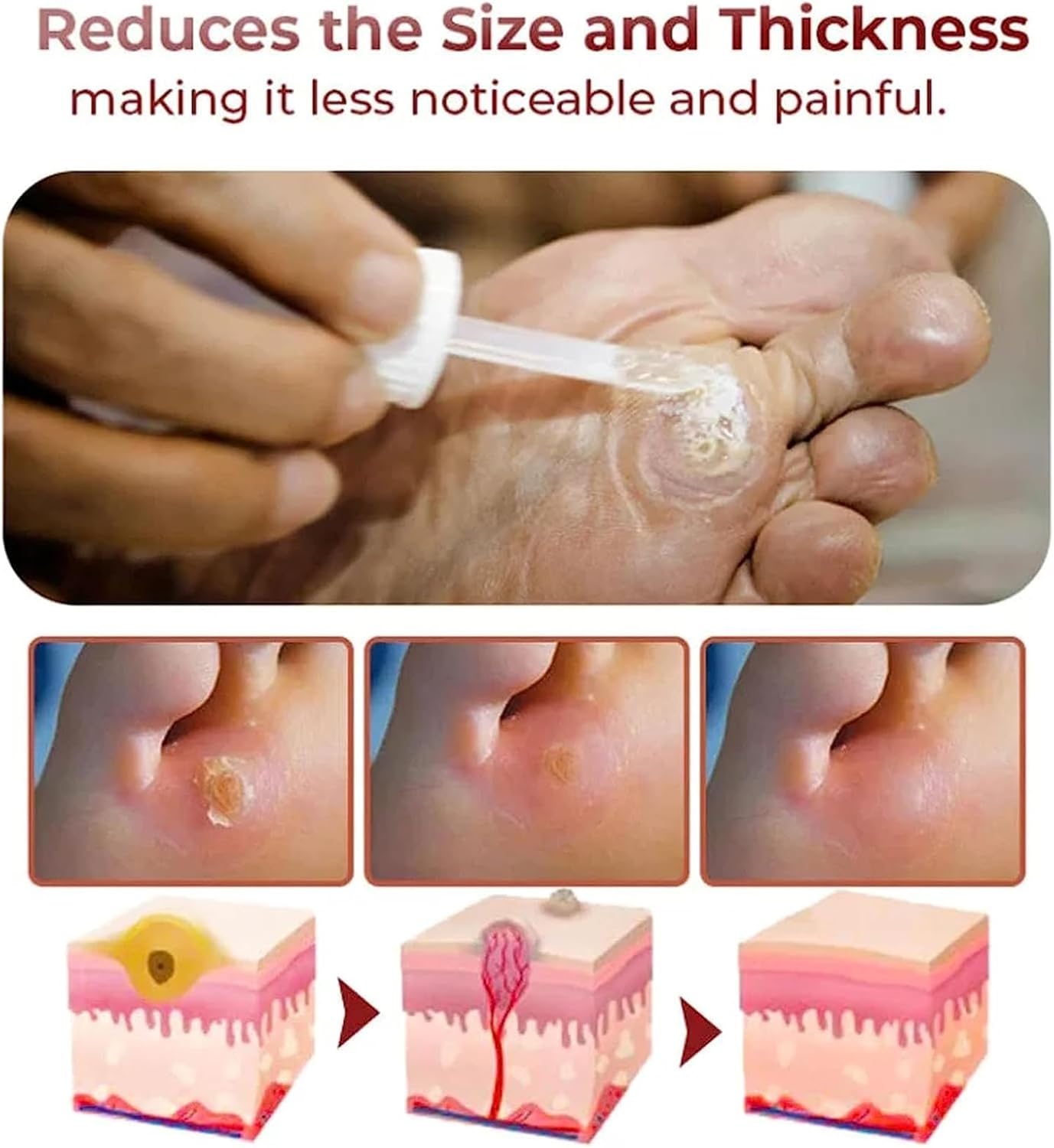 Feet Corn Removal Serum (Pack of 2) | Foot Corn Treatment Corn Healing Feet Corn Removal Serum (Pack of 2)