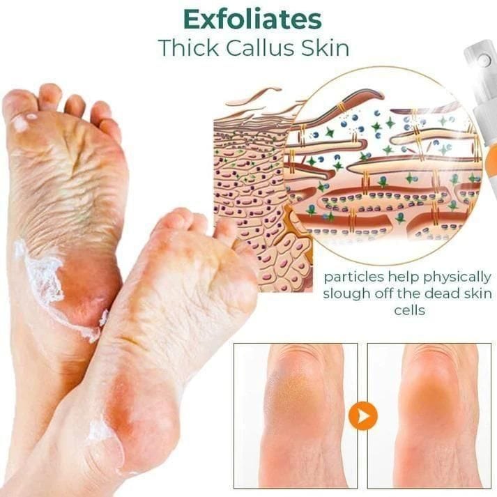 Foot Callus Removal Spray(Pack Of 2) Foot Callus Removal Spray(Pack Of 2)