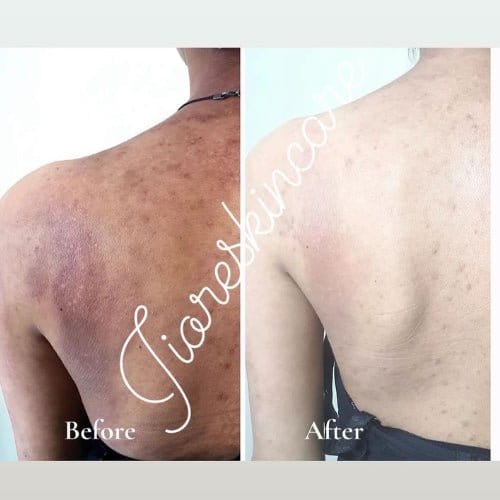 Kojic Body Soap | Skin Whitening Soap Dark Spots On Skin Tone Kojic Body Soap (Pack of 3)