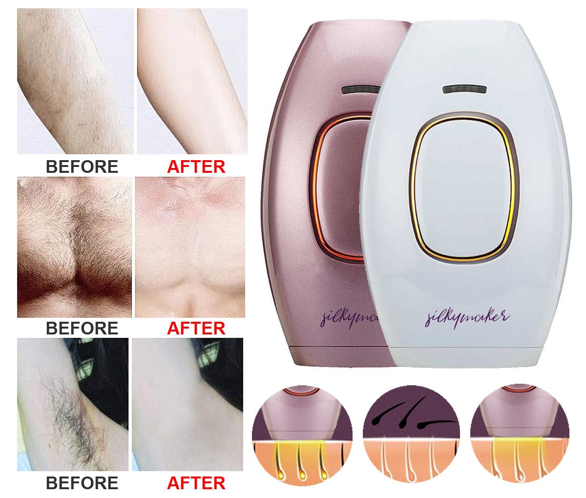 Laser Hair Removal At Home Painless Device Portable - Handheld Laser Hair Removal Device Epilators Handheld Laser Hair Removal Device