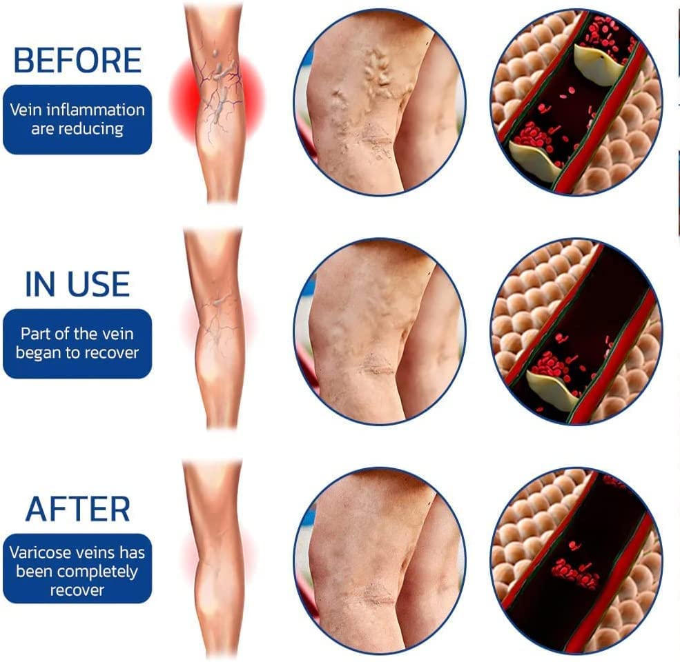 Herbal Varicose Vein Oil - Buy 1 Get 1 Free Herbal Varicose Vein Oil - Buy 1 Get 1 Free