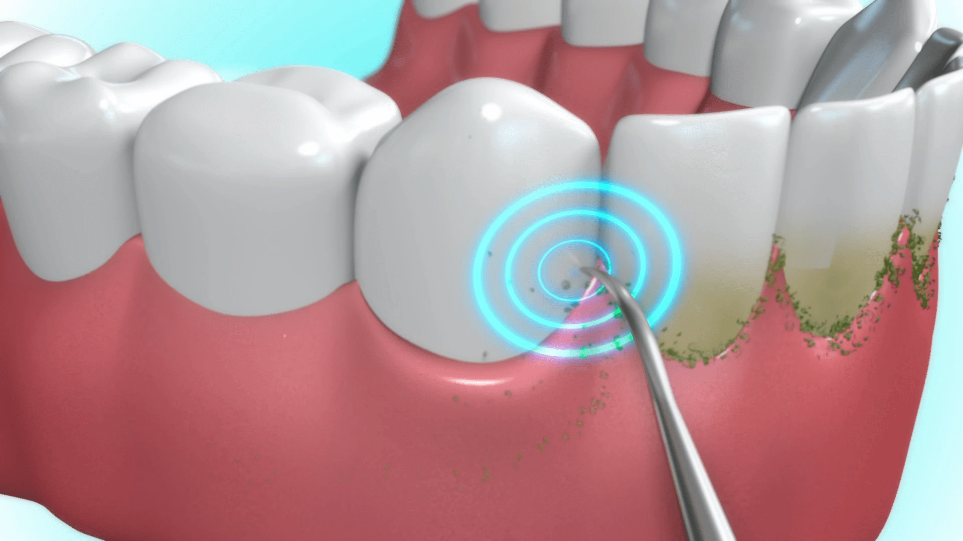 Ultrasonic Scalar Tooth Cleaner at Home Teeth Stain Remover Machine Teeth Whitening Ultrasonic Scalar Tooth Cleaner